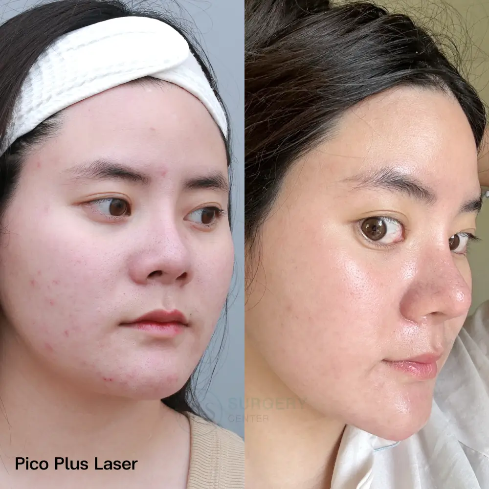 รีวิว Pico Plus Laser