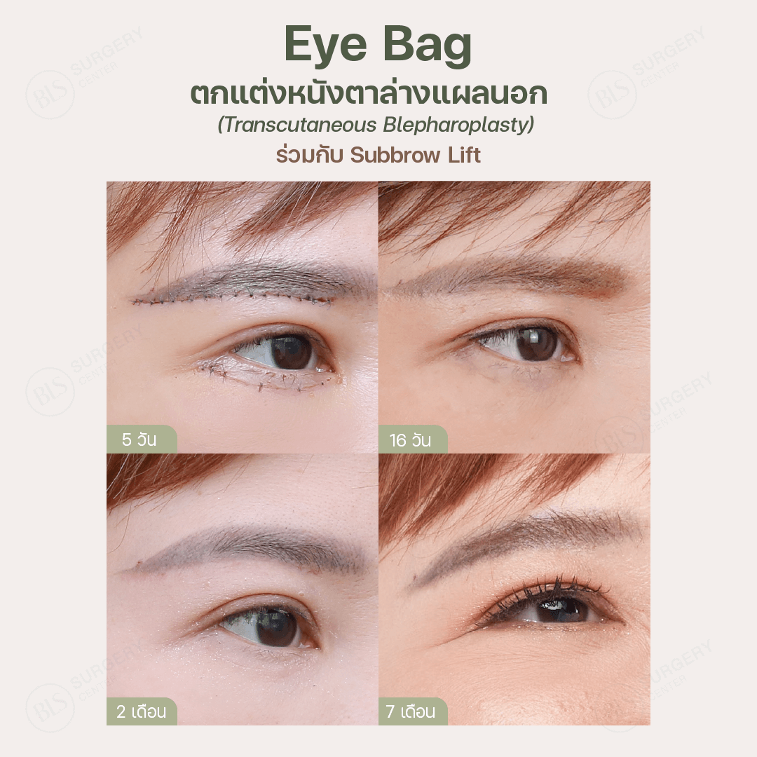 ตกแต่งหนังตาล่างแผลนอก แผลเนียนไปกับขอบตาล่าง |(Transcutaneous Blepharoplasty)