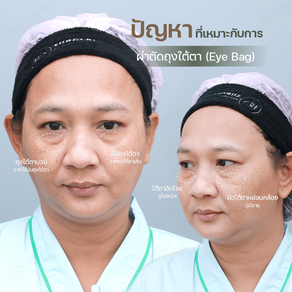 ปัญหาที่เหมาะกับการผ่าตัดถุงใต้ตา | ผ่าตัดถุงใต้ตา