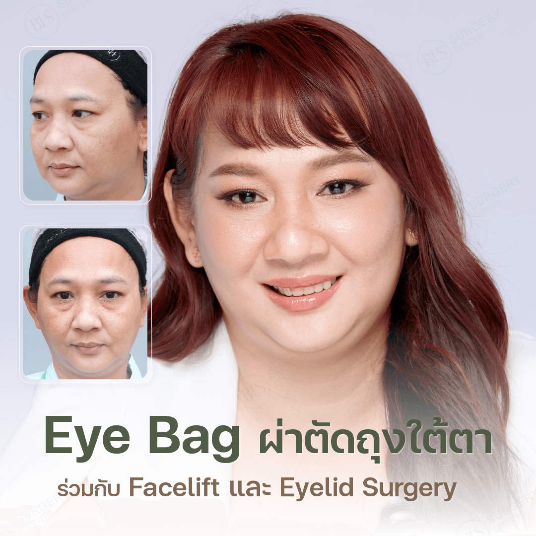 ผ่าตัดถุงใต้ตา พร้อมกับการทำตาสองชั้น (Eyelid Surgery) หรือการผ่าตัดดึงหน้า (Facelift)