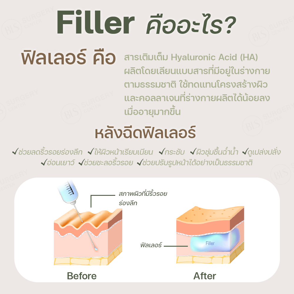 Filler คืออะไร?