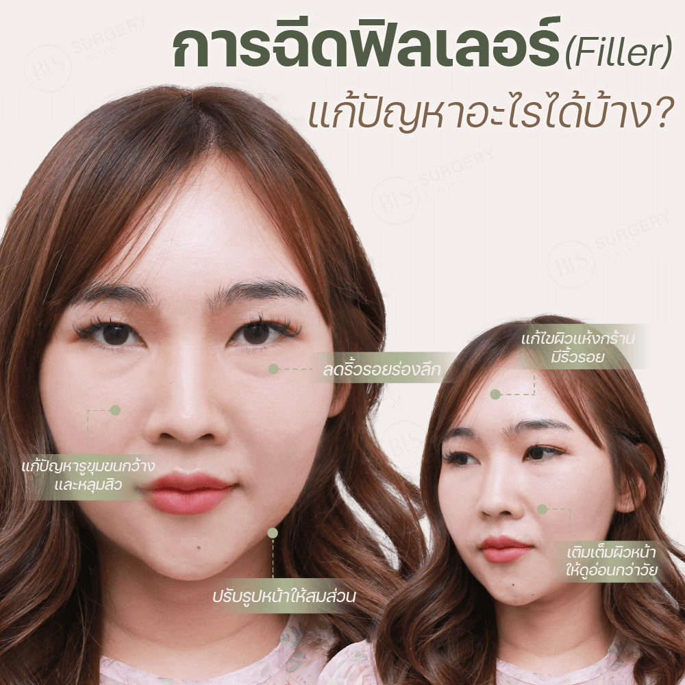 การ ฉีดฟิลเลอร์ (Filler) แก้ปัญหาอะไรได้บ้าง?