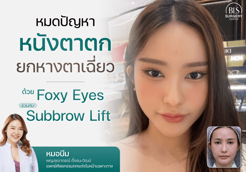 บอกลาปัญหา หนังตาตก ยกหางตาเฉี่ยว ด้วยการ ทำ Foxy Eyes & Subbrow Lift