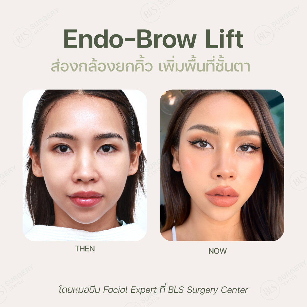 ผลลัพธ์หลังส่องกล้องยกคิ้ว Endo-Brow Lift