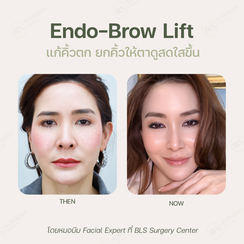 Results after Endo-Brow Lift2