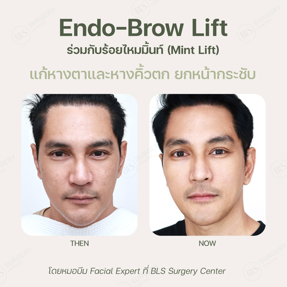 ผลลัพธ์หลังส่องกล้องยกคิ้ว Endo-Brow Lift