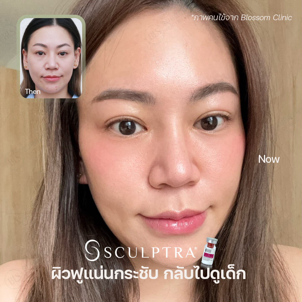 ผลลัพธ์หลัง ฉีด Sculptra