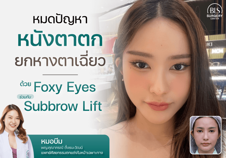 บอกลาปัญหา หนังตาตก ยกหางตาเฉี่ยว ด้วยการ ทำ Foxy Eyes & Subbrow Lift