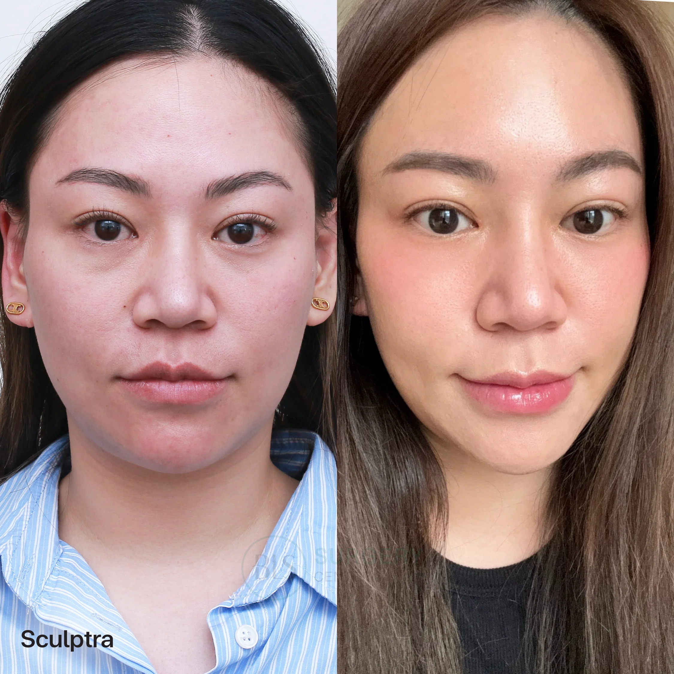 รีวิว Sculptra ผิวหน้าหย่อนคล้อย