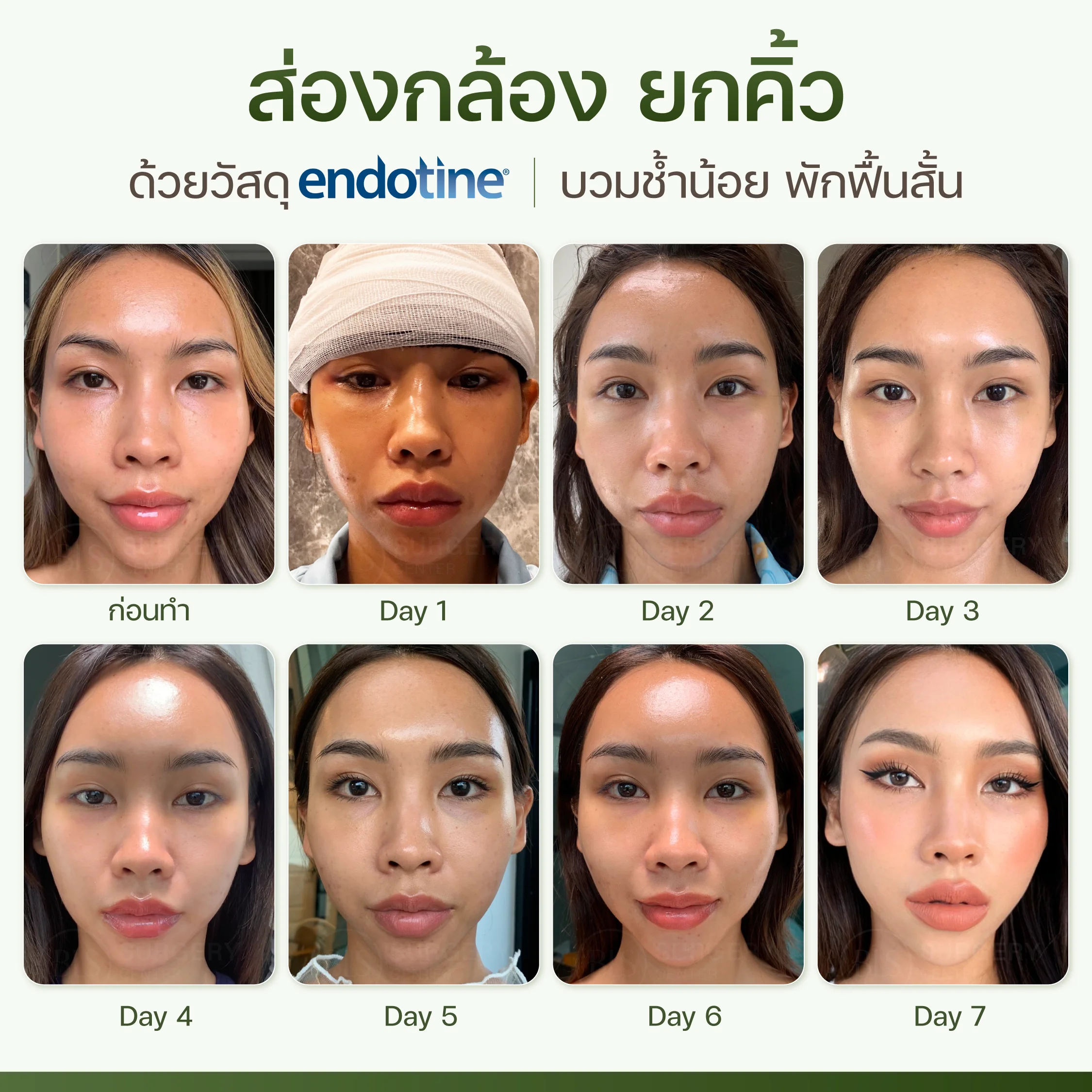 ส่องกล้อง ยกคิ้ว ด้วยวัสดุ endotine