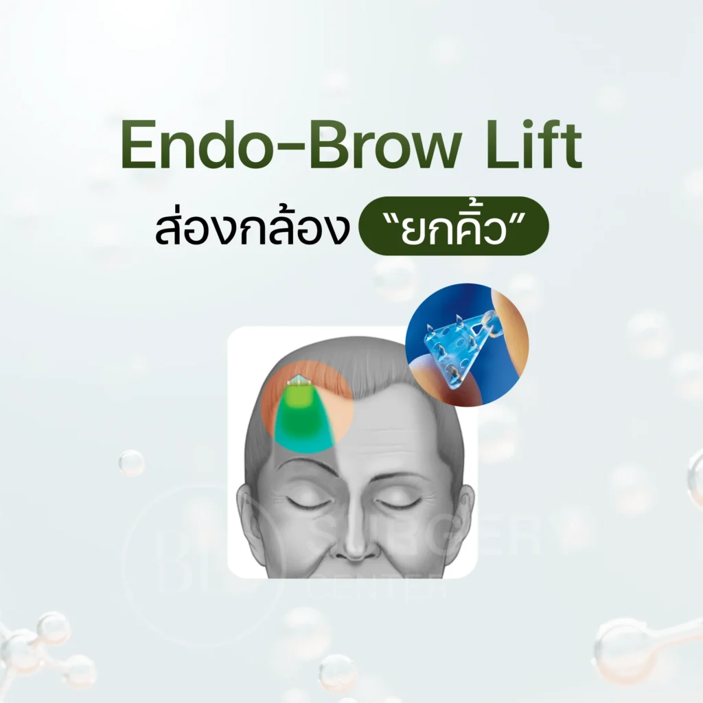 Endo face lift ส่องกล้อง "ยกคิ้ว"