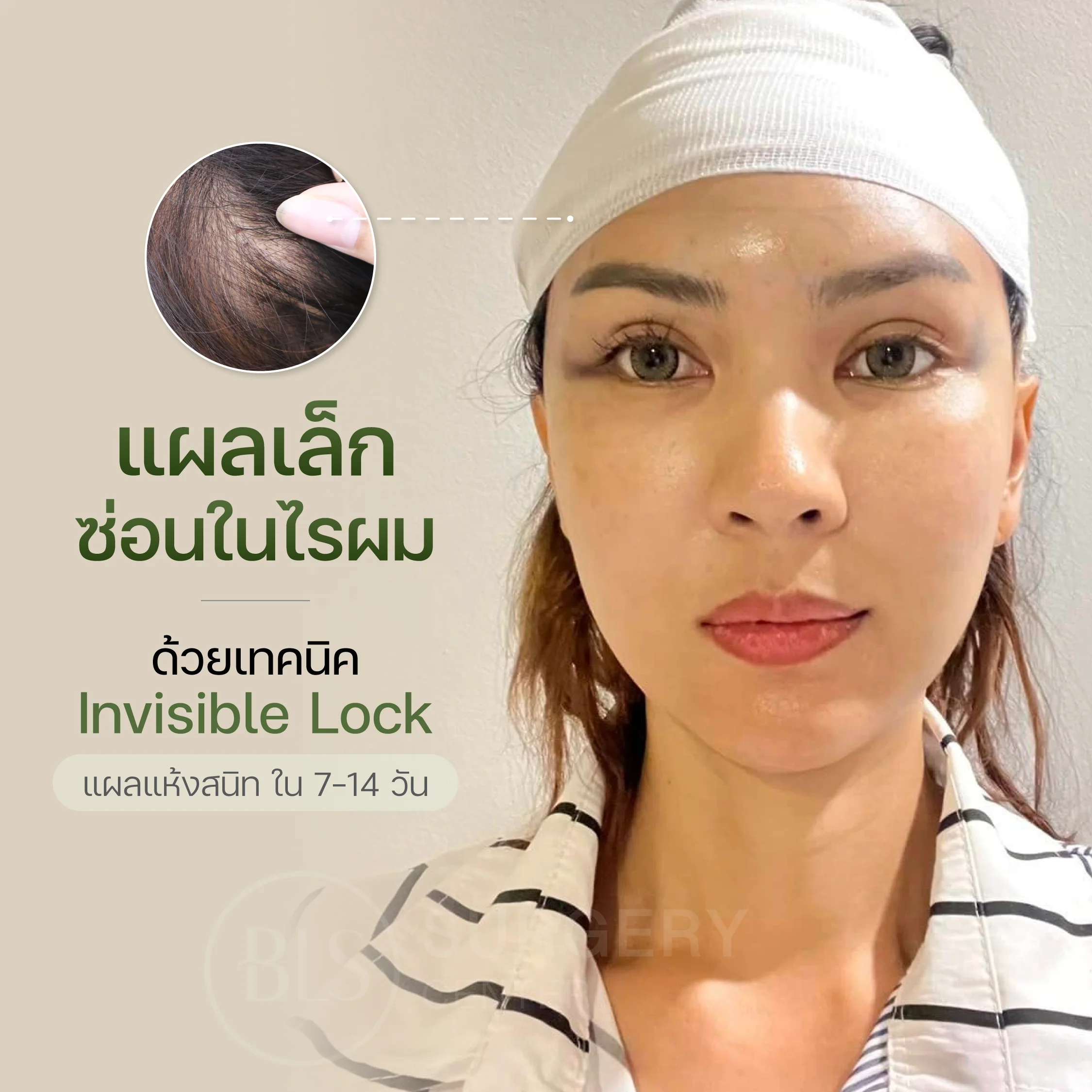 แผลเล็กซ่อนในไรผม ด้วยเทคนิค Invisible Lock