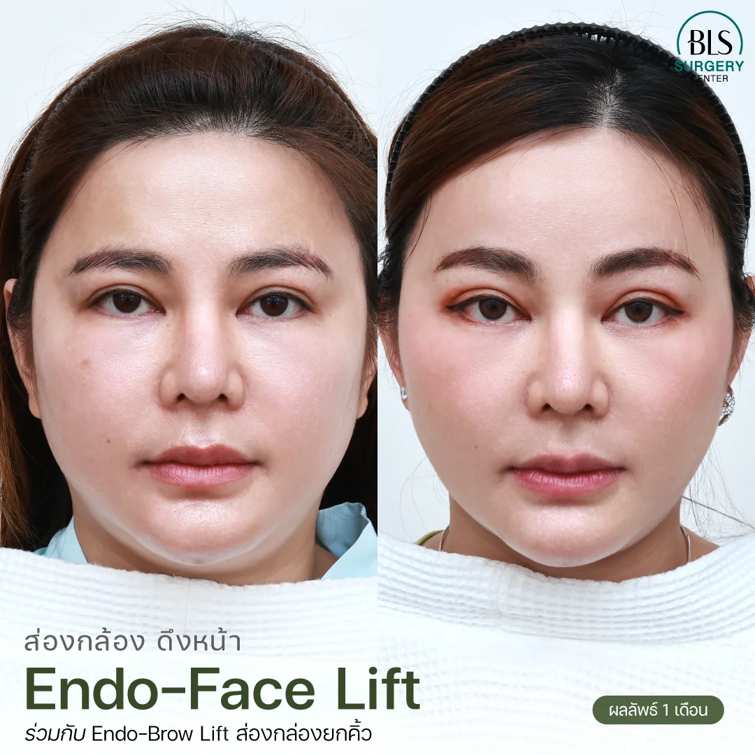 Endo-face-lift& endo-Brow Lift โดยหมอบีม Endotine