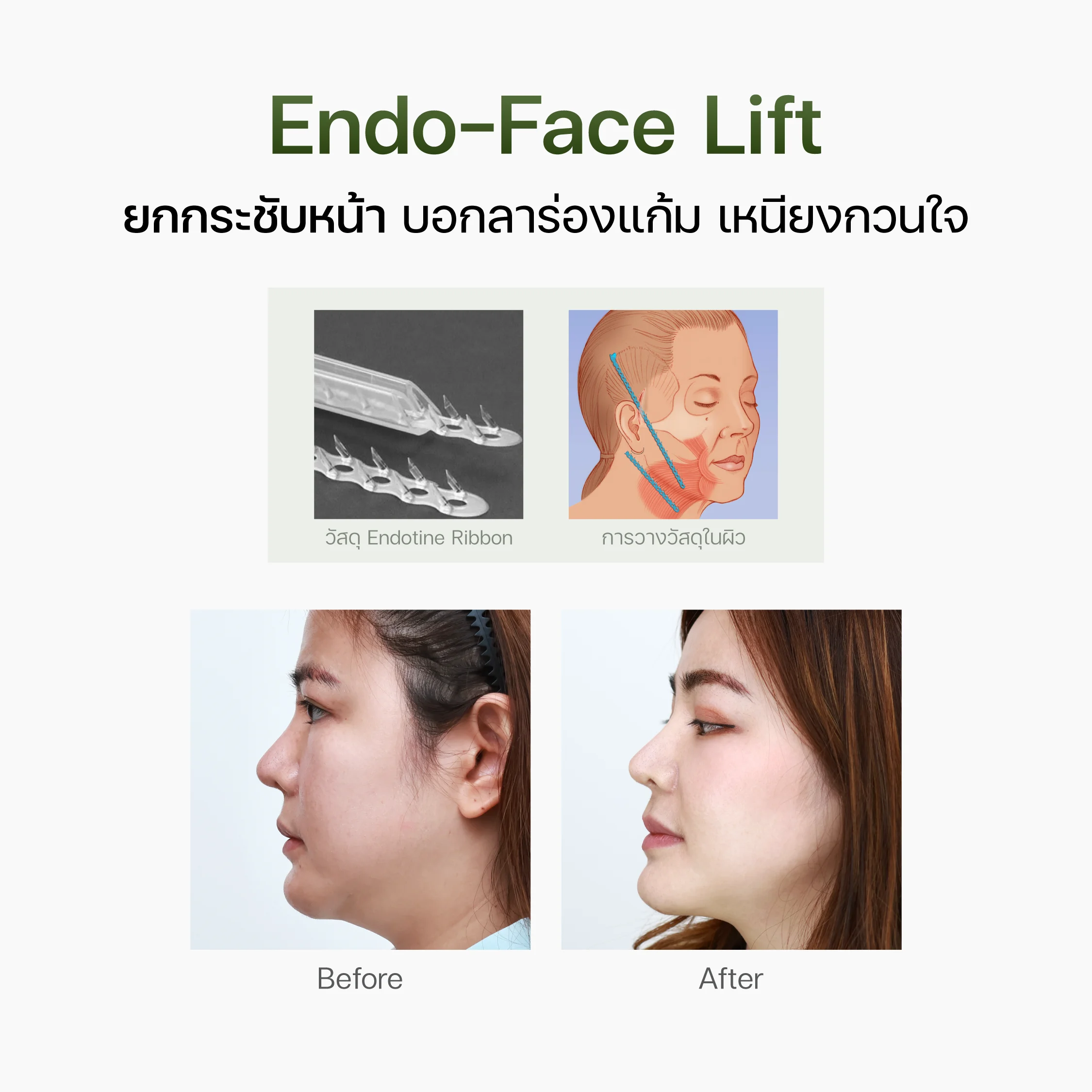 Endo-Face Lift ยกกระชับหน้า บอกลาร่องแก้ม และเหนียง | endo face lift