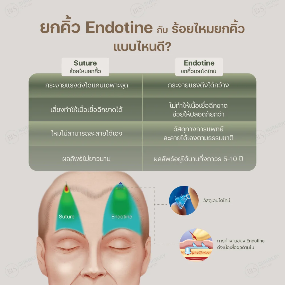 ยกคิ้วด้วย Endotine คิ้วยกได้นานกว่าการร้อยไหมยกคิ้ว