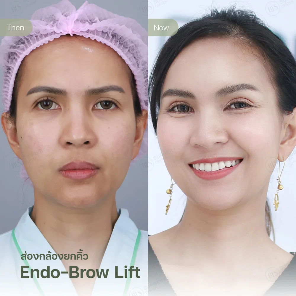 ยกคิ้วด้วยเอนโดไทน์ (Endo-Brow Lift) แก้คิ้วตก ตาดุ