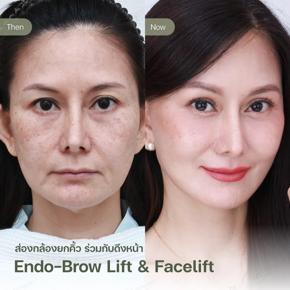  ยกคิ้วด้วยเอนโดไทน์ (Endo-Brow Lift) แก้หางตาตก