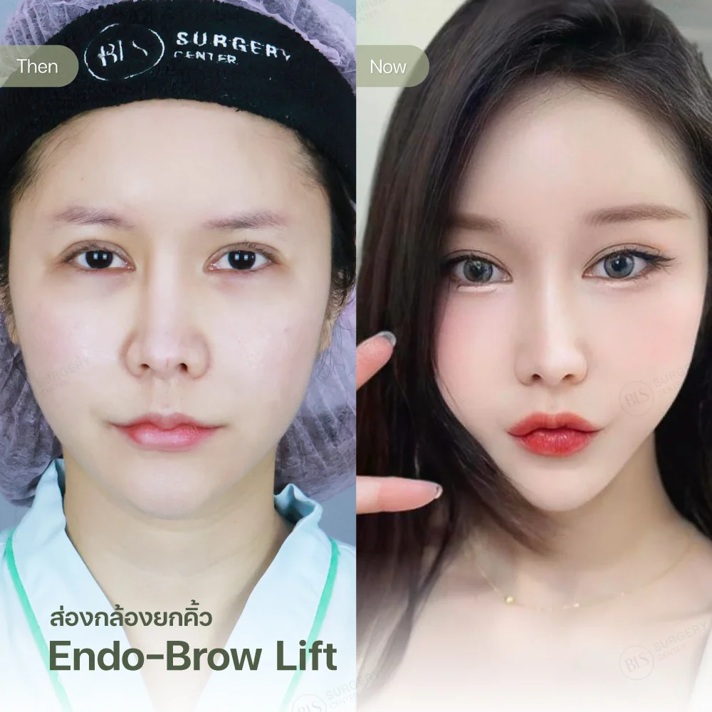 ยกคิ้วด้วยเอนโดไทน์ (Endo-Brow Lift) แก้คิ้วและชั้นตาแคบ