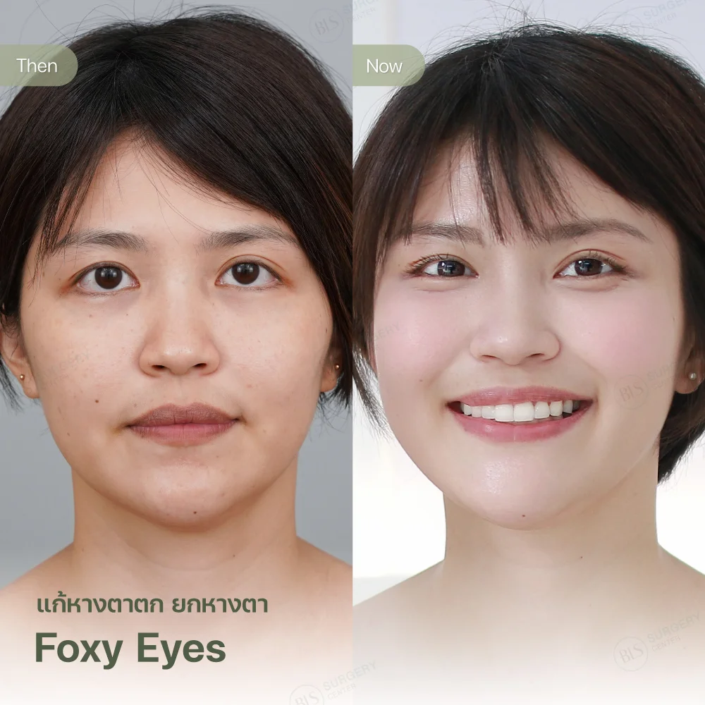 ยกหางตา Foxy Eyes แก้คิ้วตก หางตาตก