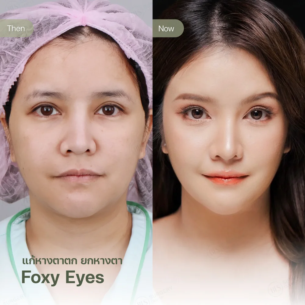 ยกหางตา Foxy Eyes แก้หางคิ้วตก หนังตากองหางตา