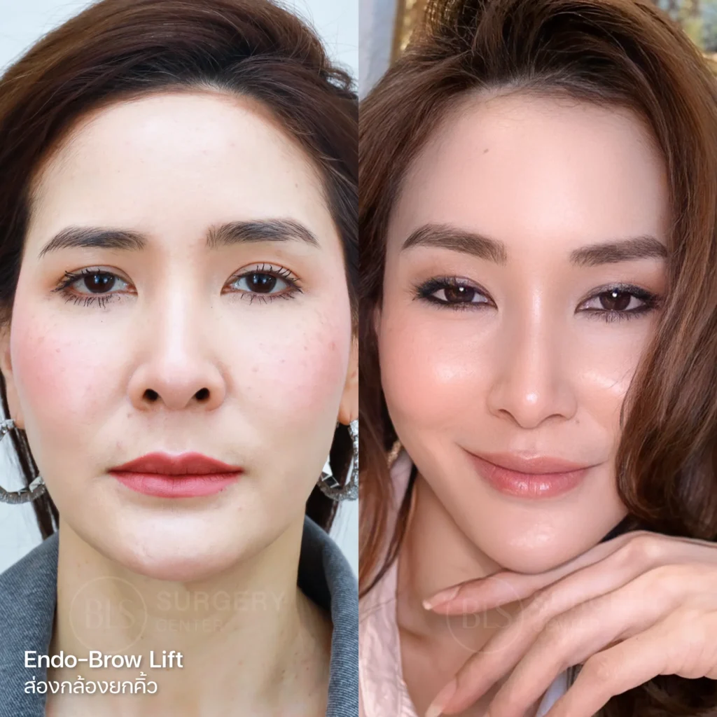 ยกคิ้วด้วยเอนโดไทน์ (Endo-Brow Lift) แก้คิ้วสองข้างไม่เท่ากัน