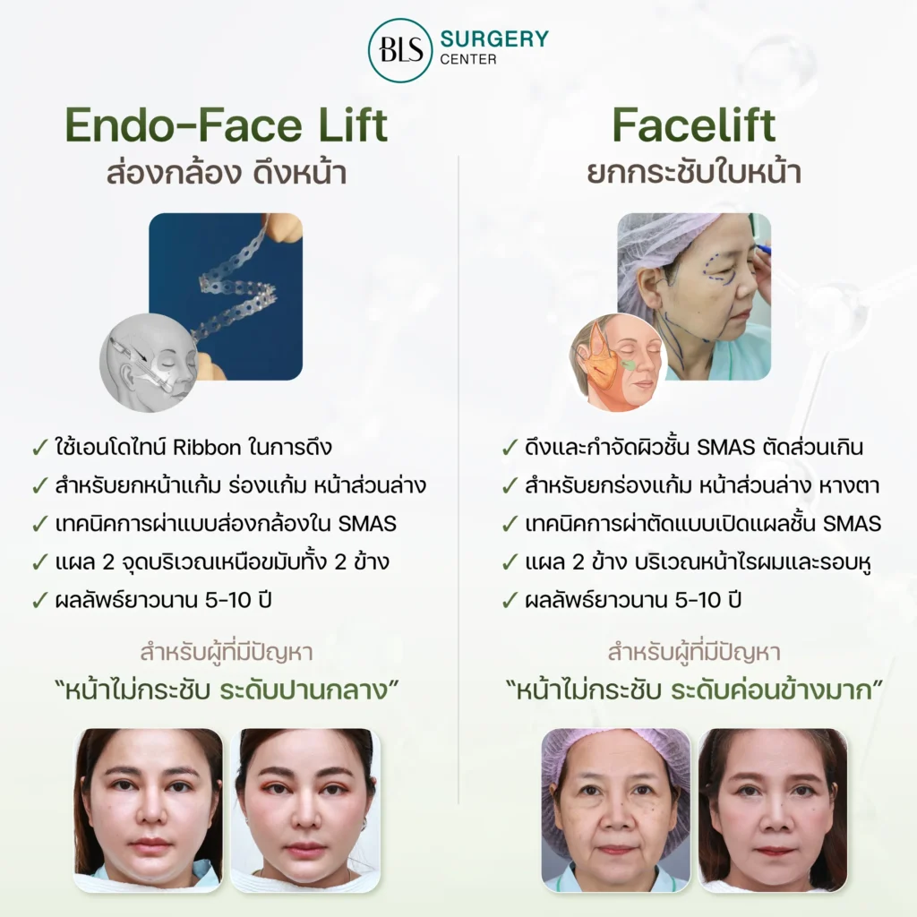 Endo-Face Lift ต่างจาก Facelift อย่างไร?