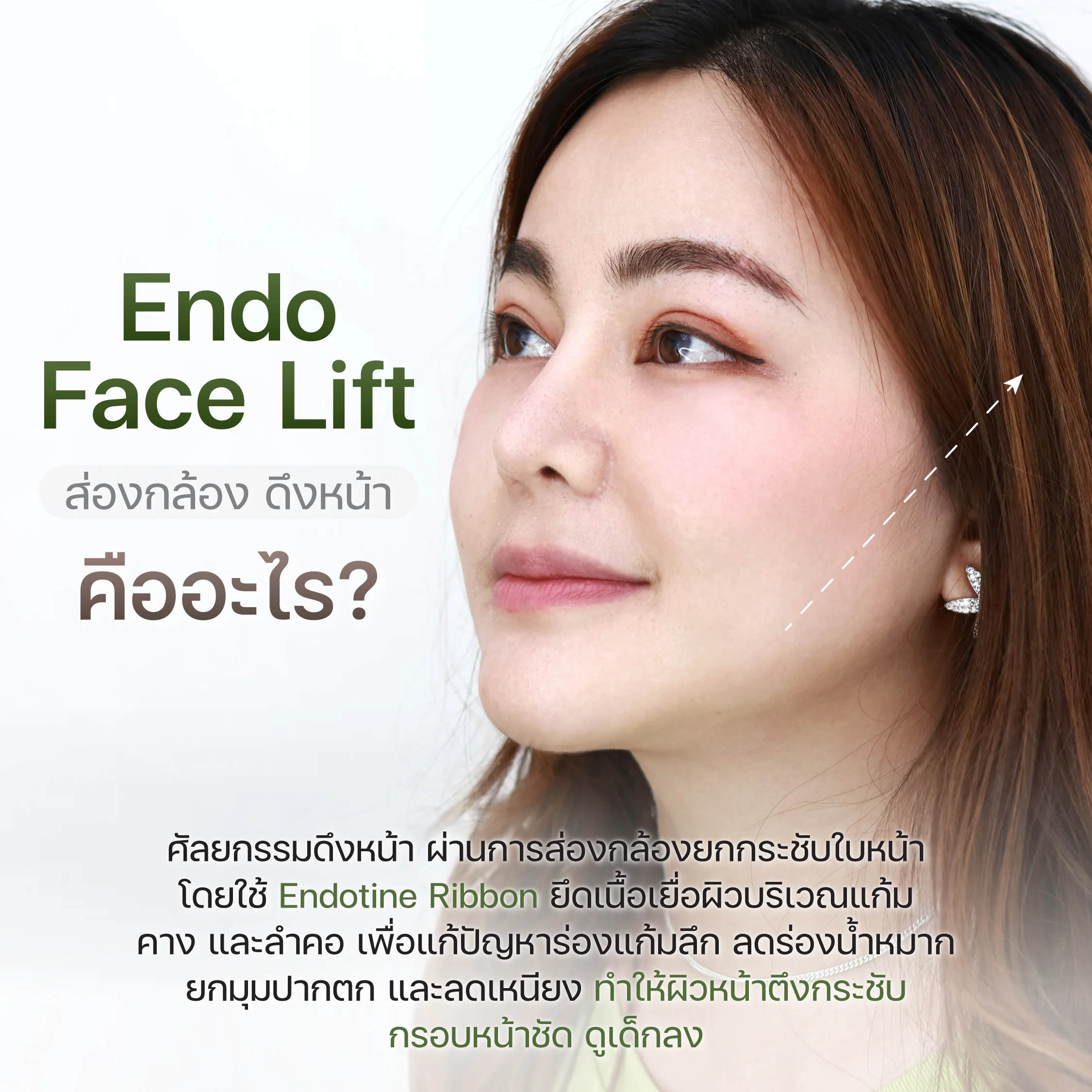 บอกลา “หน้าไม่กระชับ” ส่องกล้องดึงหน้า ( Endo Face Lift )