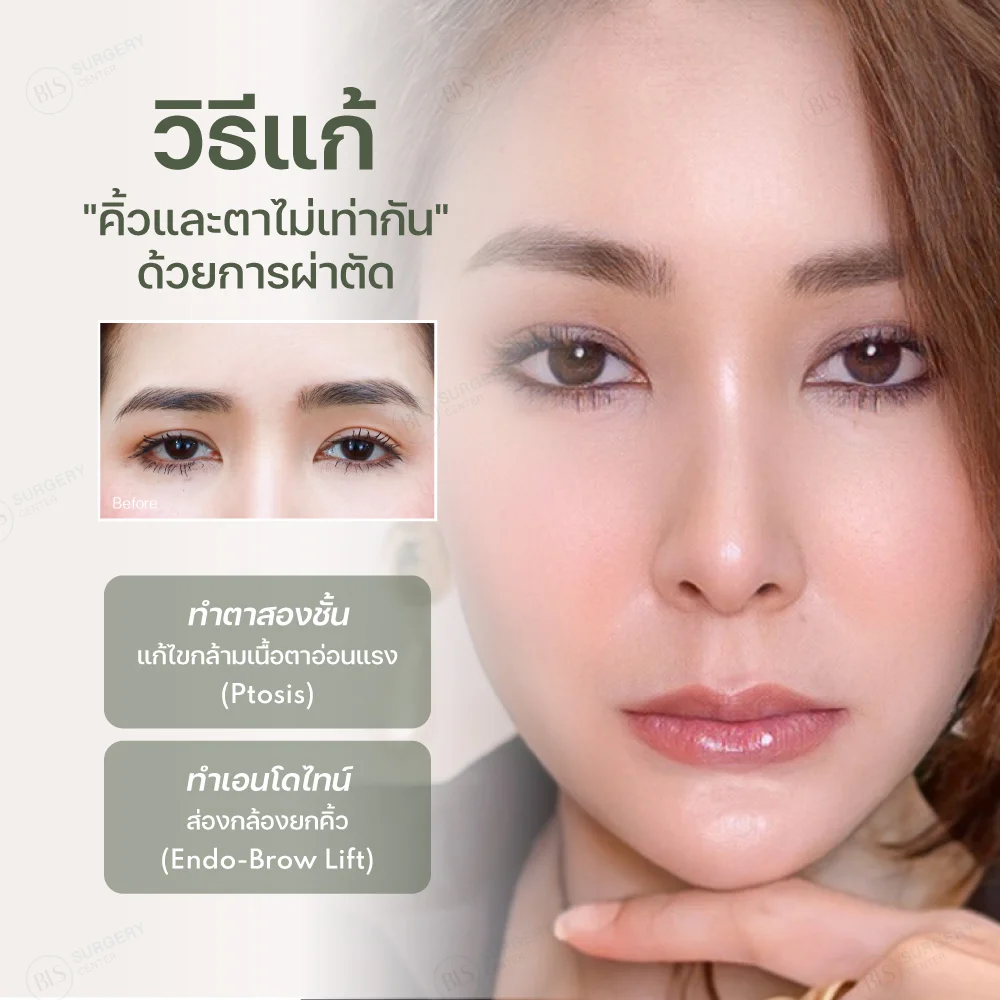 คิ้วและตาไม่เท่ากัน วิธีแก้แบบผ่าตัด Endo-Brow Lift ส่องกล้องยกคิ้ว (Endoscopic brow lift)