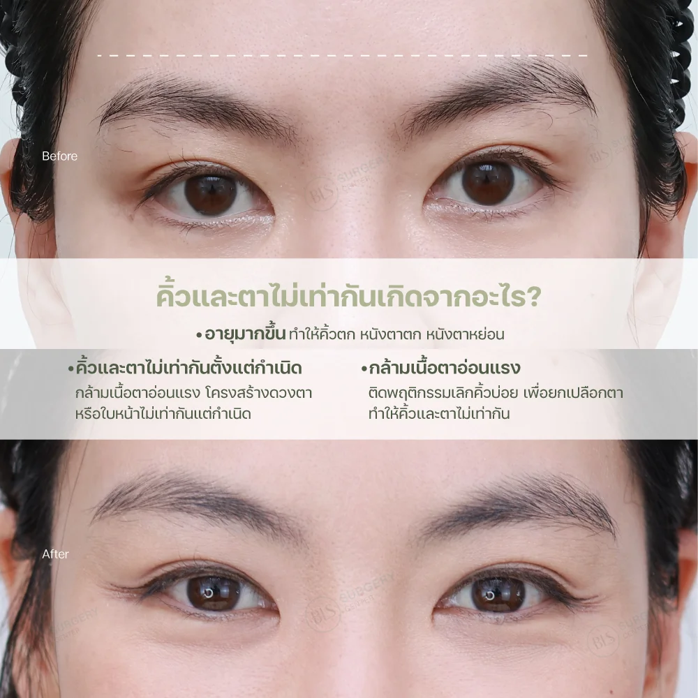 คิ้วและตาไม่เท่ากันเกิดจากอะไร?