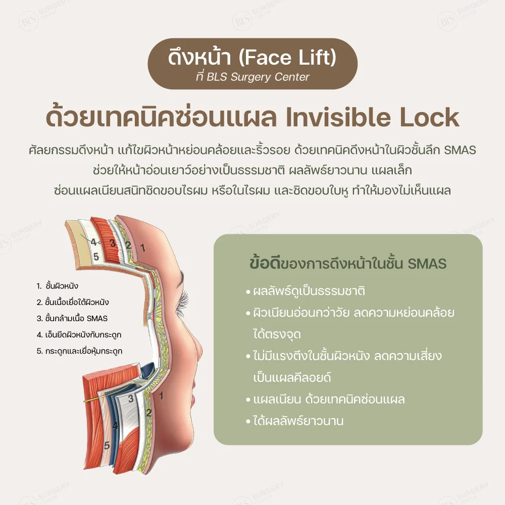 ข้อดีของการดึงหน้า ซ่อนแผลเนียน ด้วยเทคนิค Invisible Lock