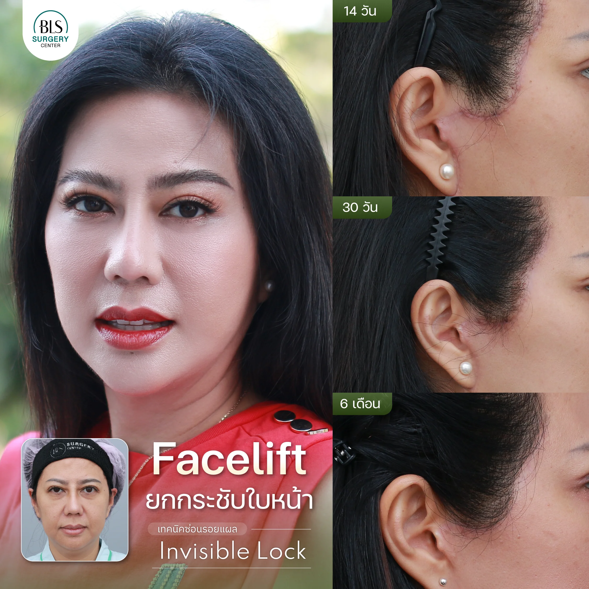 เคสคุณปุ๋มปิ๋ม Face Lift ยกกระชับหน้า เทคนิค Invisible Lock