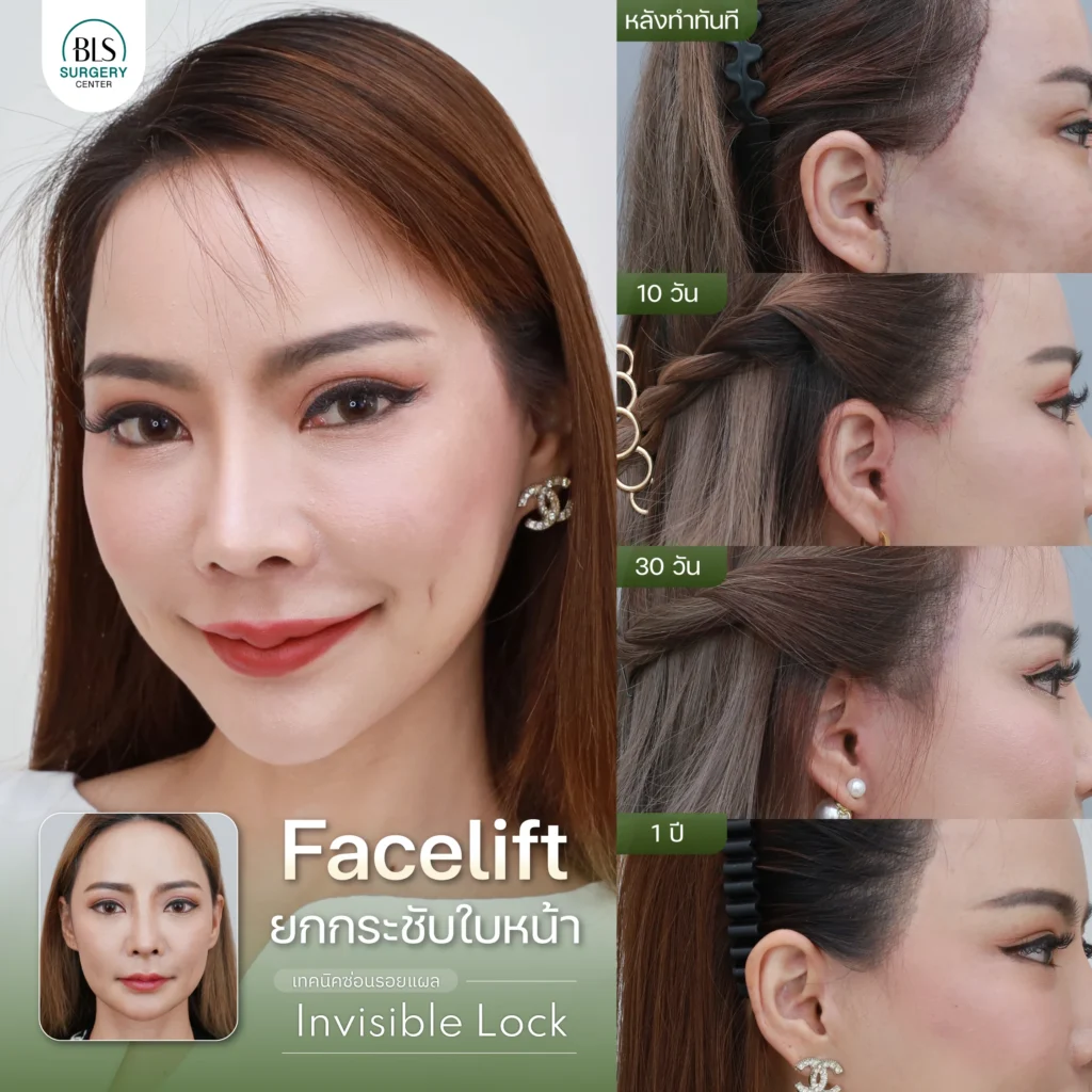 เคสคุณหยก Face Lift ยกกระชับหน้า เทคนิค Invisible Lock