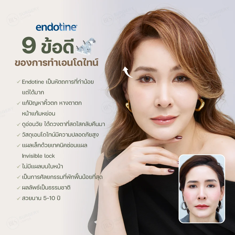 9 ข้อดีของการทำเอนโดไทน์ คืออะไรบ้าง