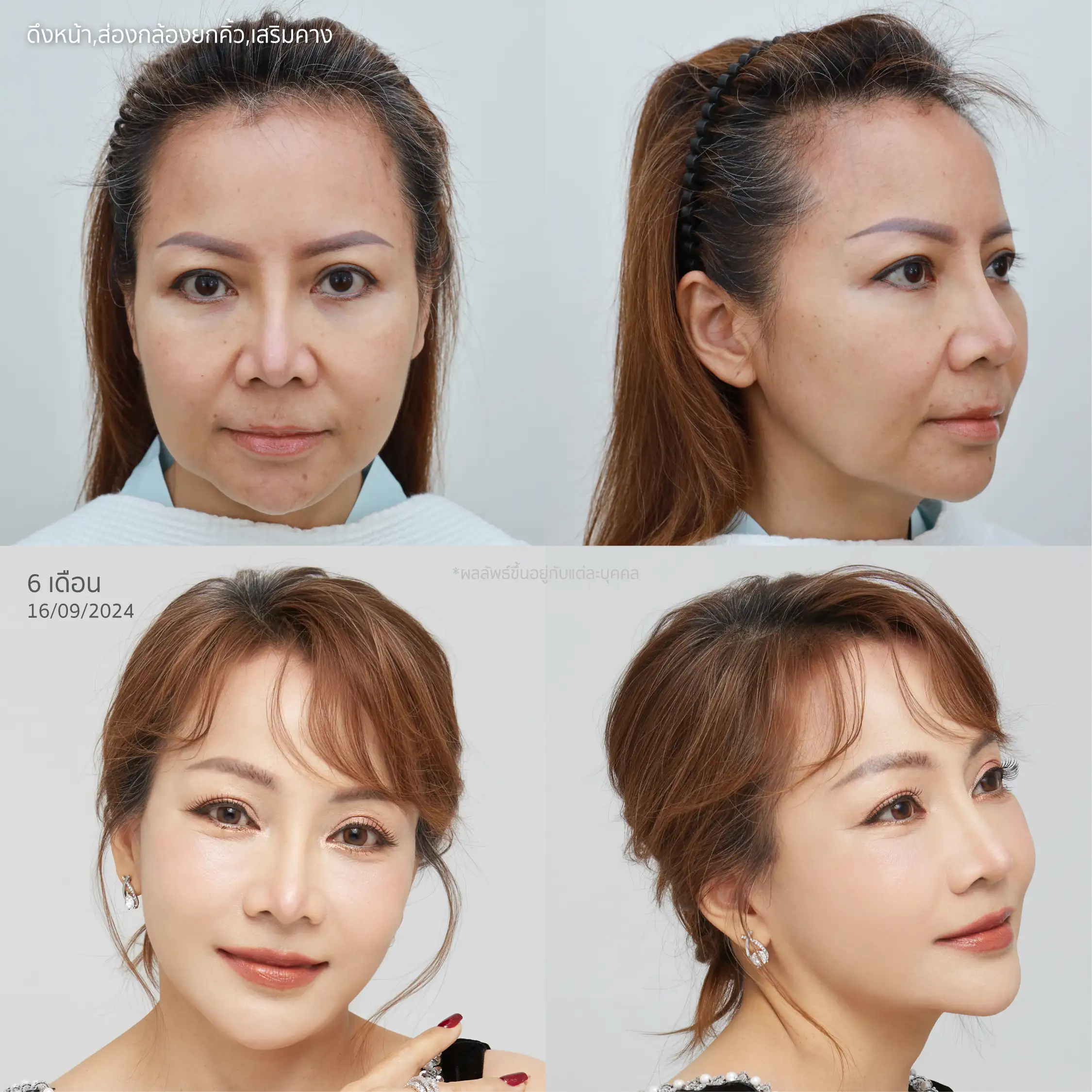 รีวิวส่องกล้องยกคิ้ว กับยกกระชับใบหน้า