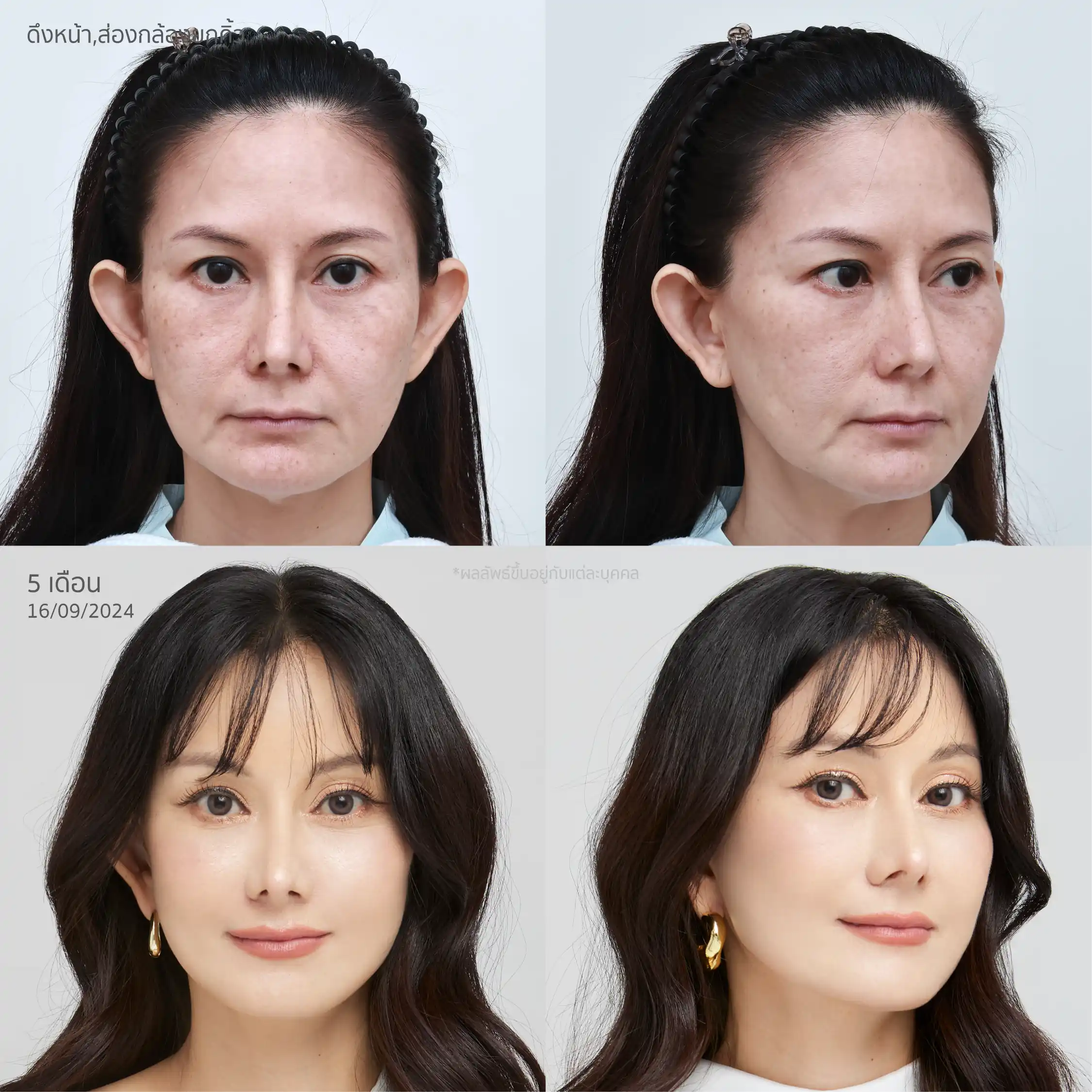 รีวิวยกกระชับใบหน้า