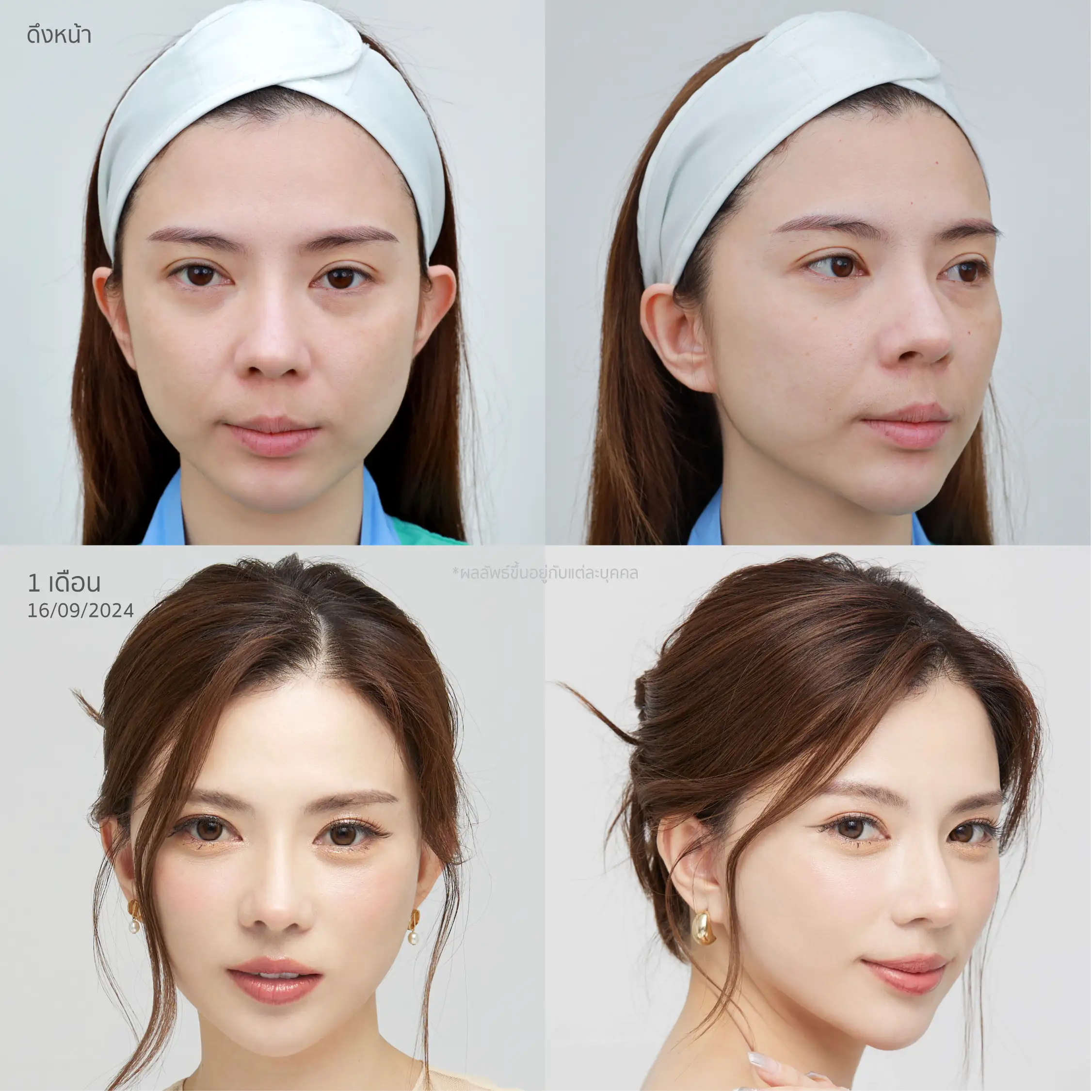 รีวิวหลังดึงหน้า