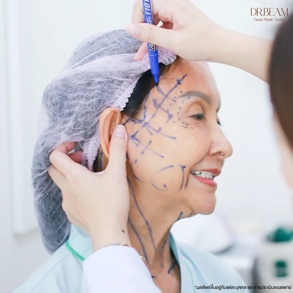 Face lift ผ่าตัดดึงหน้า ช่วยยกกระชับบริเวณกรอบหน้า