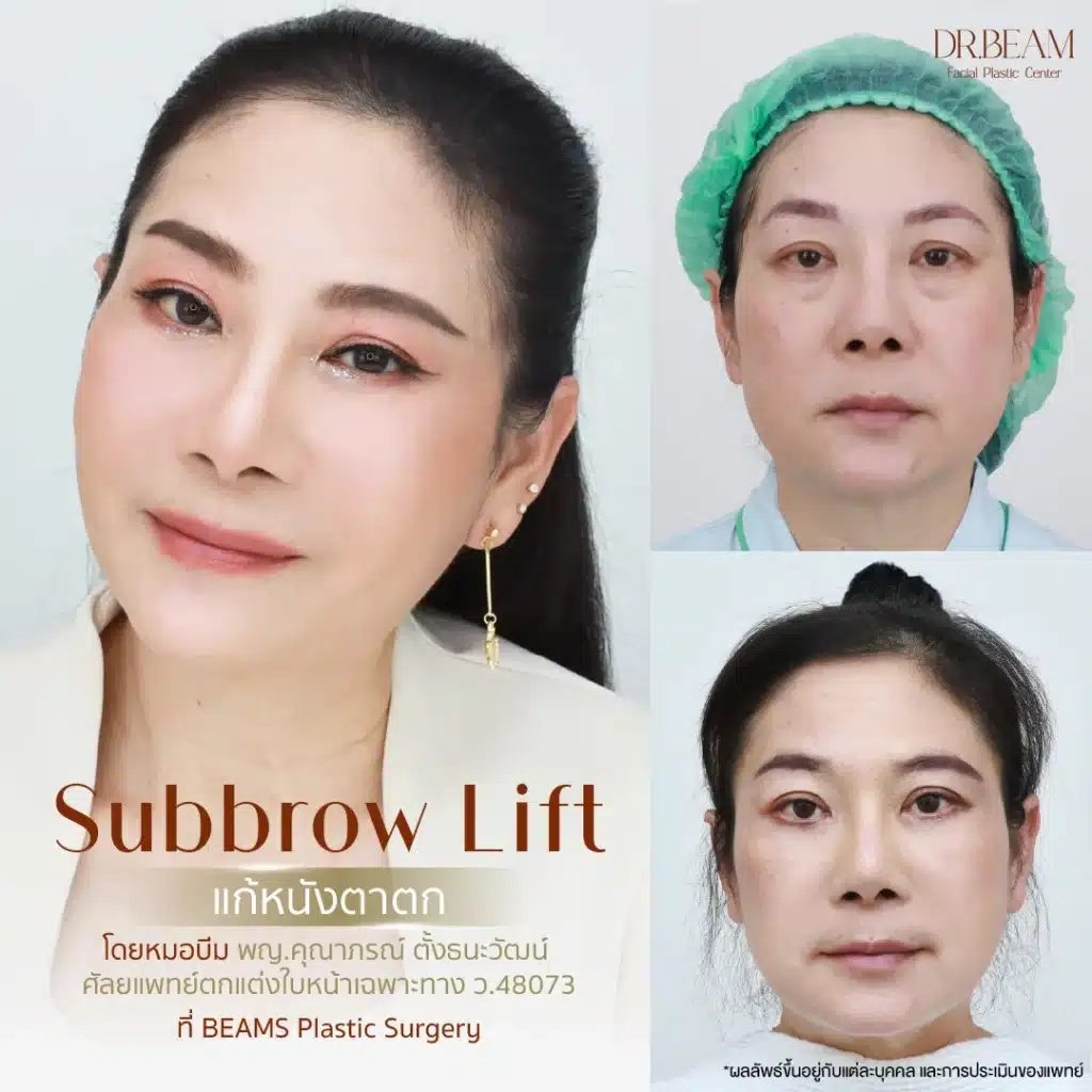 Subbrow lift
