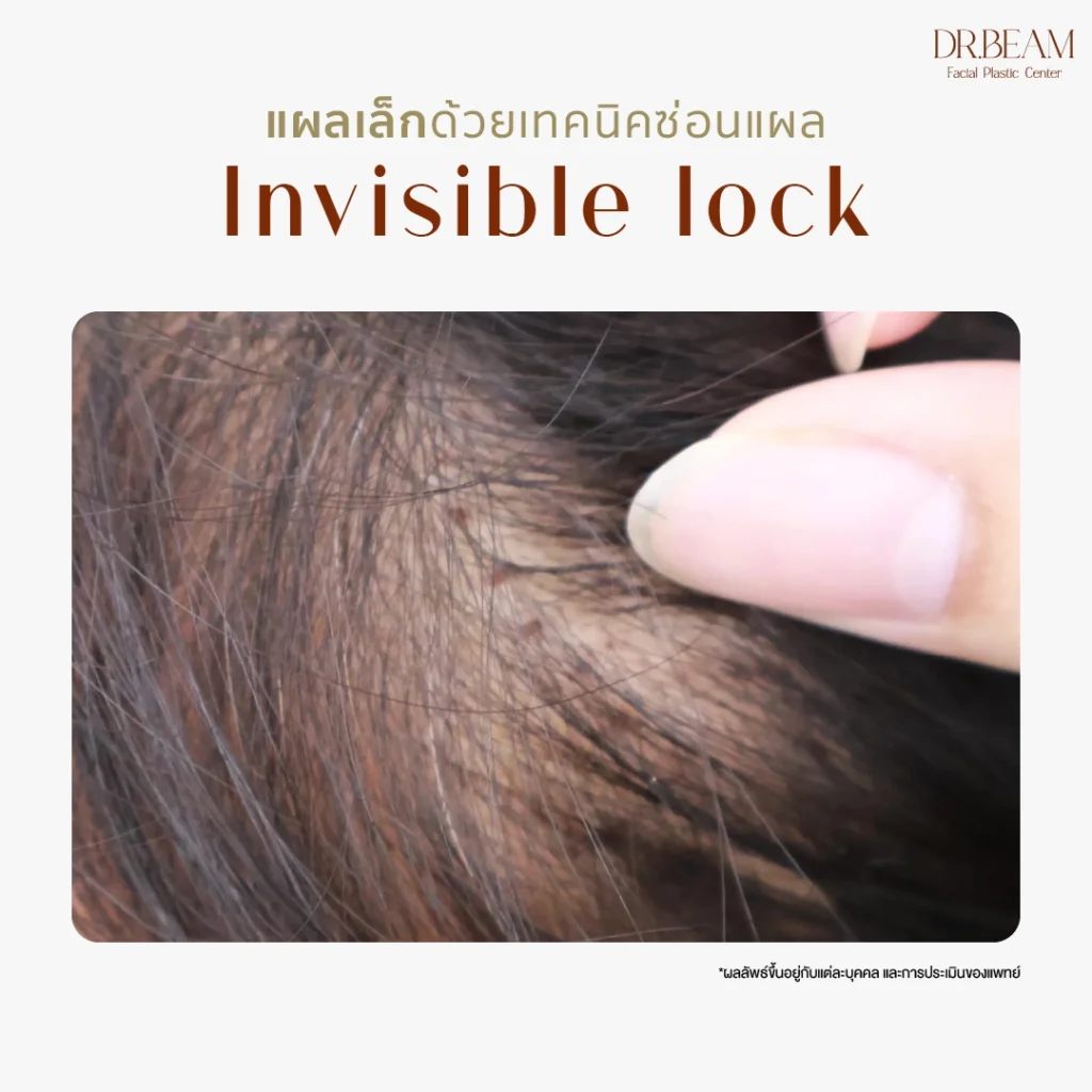 Endo-Brow Lift แผลเล็กด้วยเทคนิคซ่อนแผล Invisible lock  เอนโดไทน์ คือ