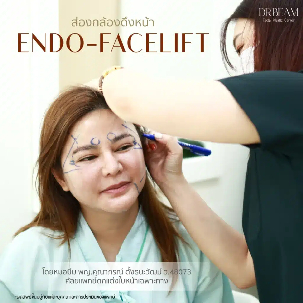 Endo-Face Lift & Endo-Browlift ออกแบบร่วมกับหมอบีม Endotine