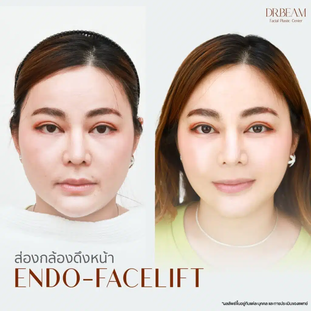 Endo-face-lift& endo-Browlift โดยหมอบีม Endotine