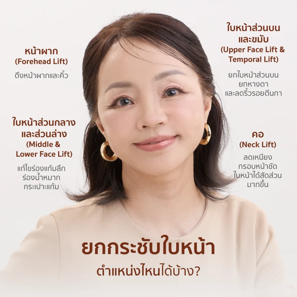 Facelift กระชับใบหน้า ตำแหน่งไหนได้บ้าง?