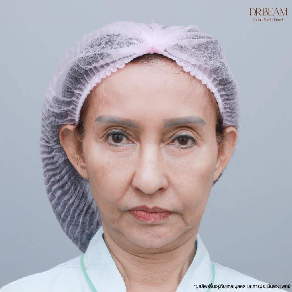 Face lift ผ่าตัดดึงหน้า เหมาะกับใครบ้าง