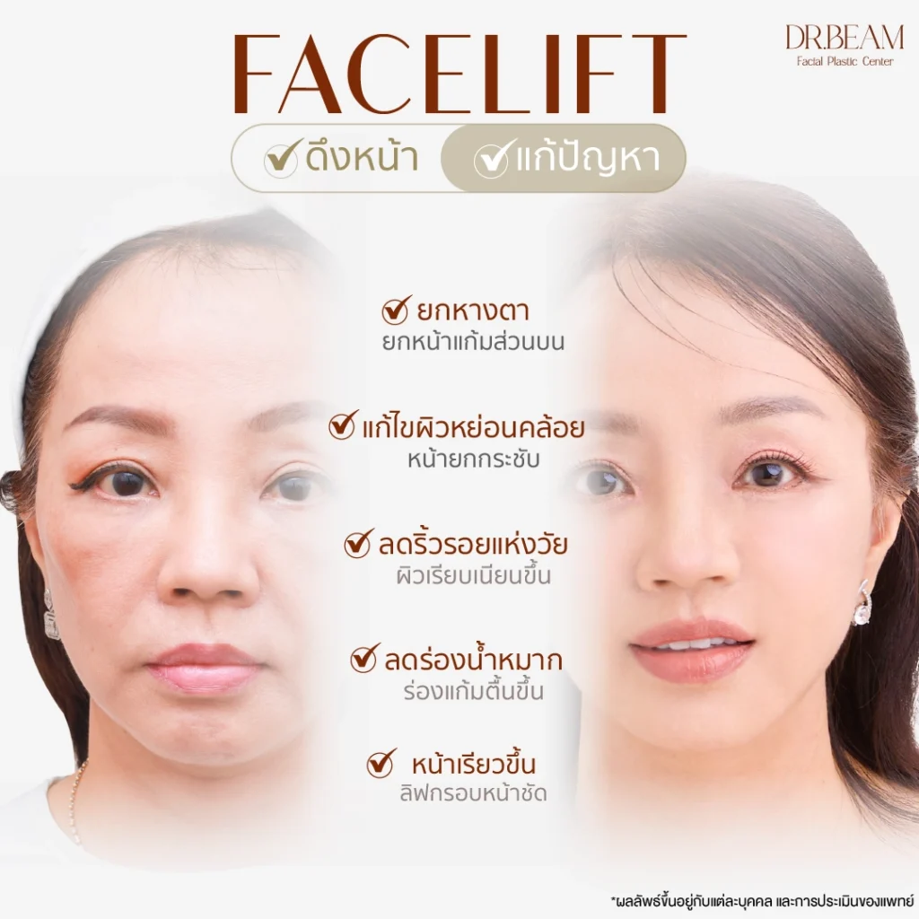 Facelift ดึงหน้า และการแก้ปัญหา