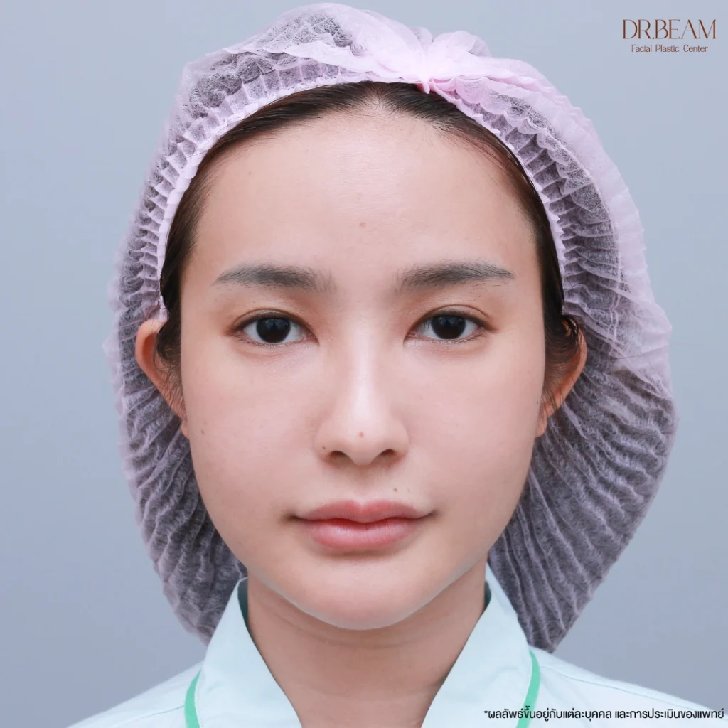 ปัญหาหนังตาตกลงมาบังชั้นตา