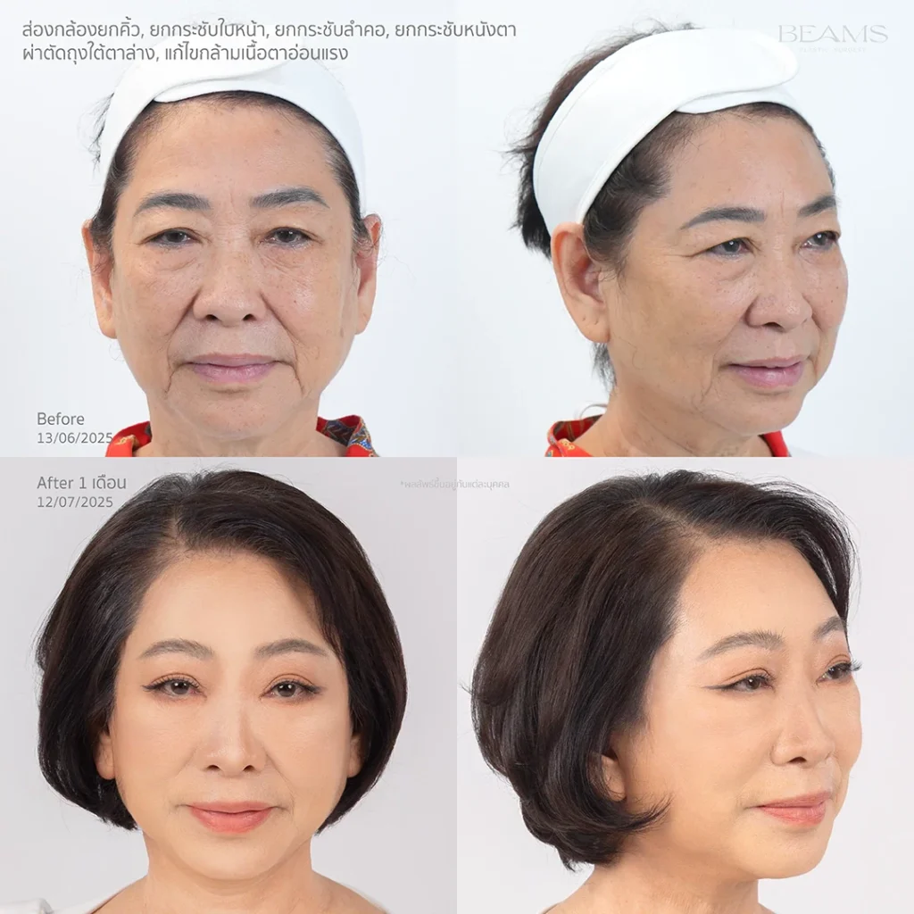 รูปเคสรีวิว Subbrow lift คุณเฮียง