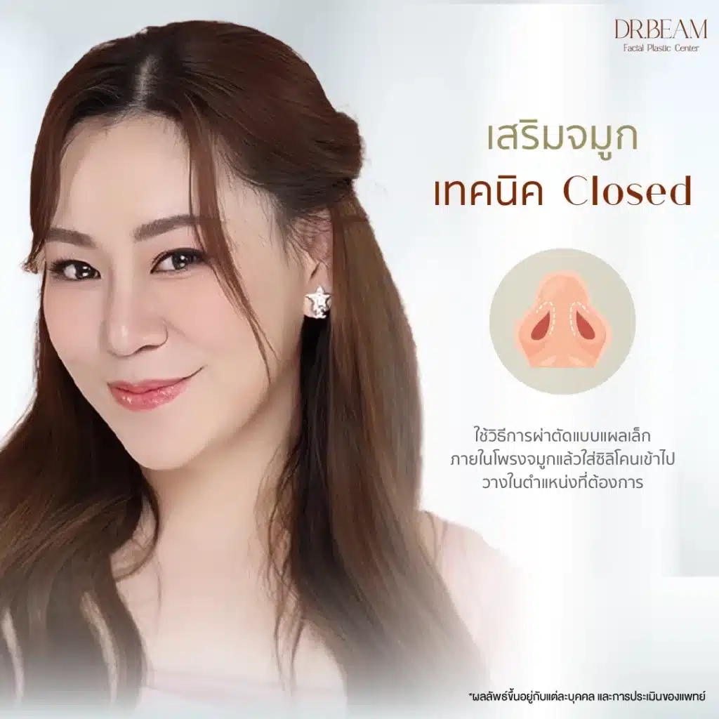 การ เสริมจมูก (Rhinoplasty) เทคนิค Closed คืออะไร? หมอบีม Facial Expert มีคำตอบ