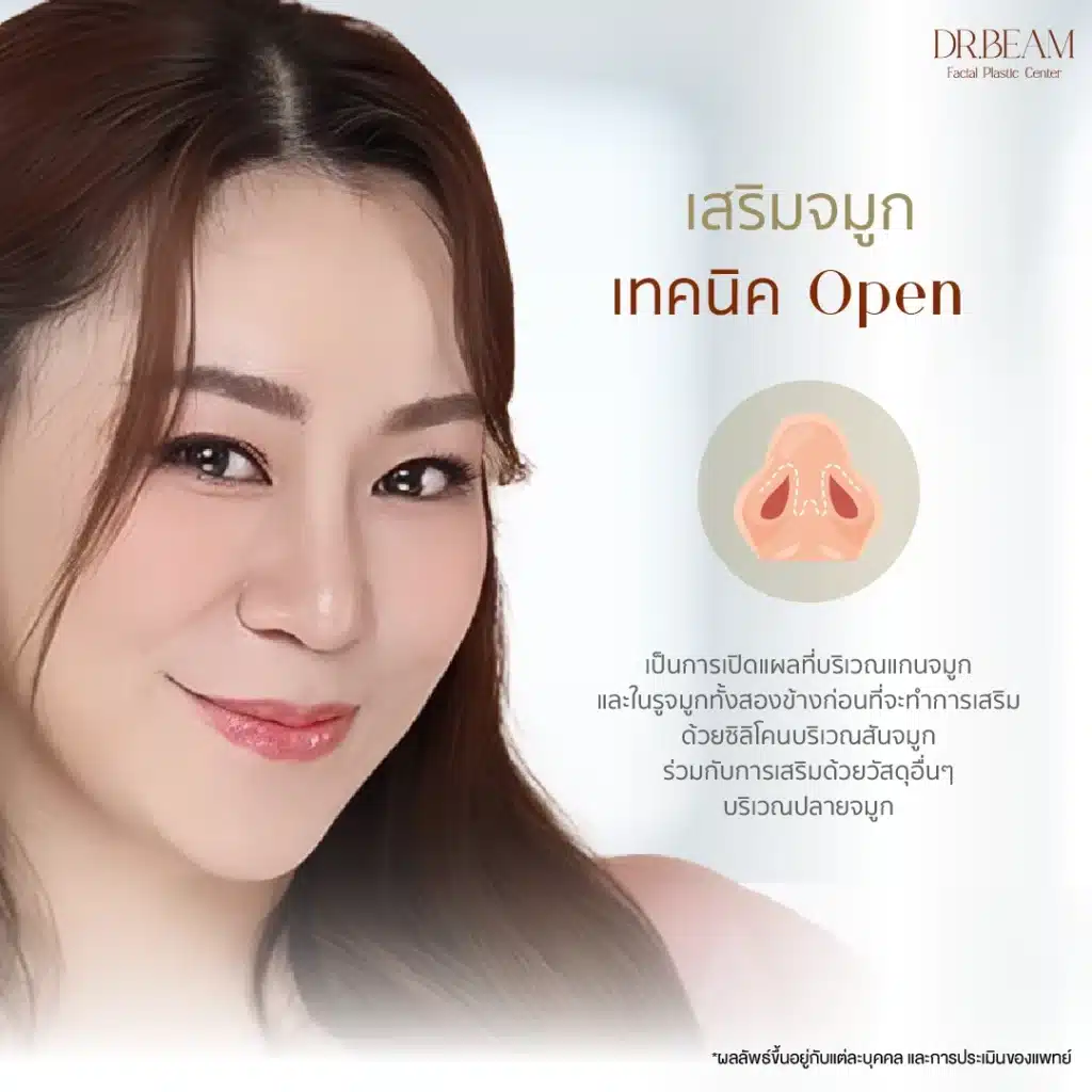 การ เสริมจมูก (Rhinoplasty) เทคนิค Open คืออะไร