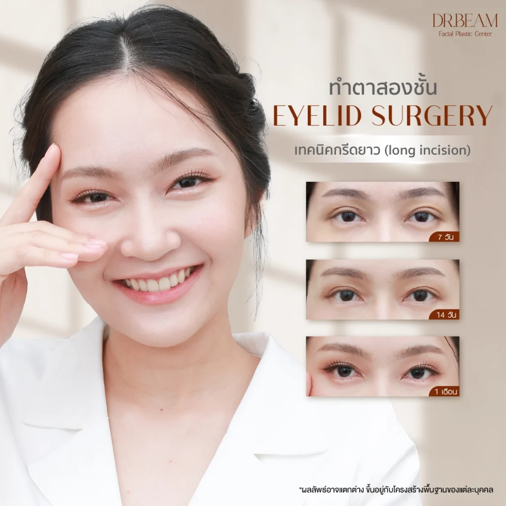 การทำตาสองชั้น เทคนิคกรีดยาว (Long incision)