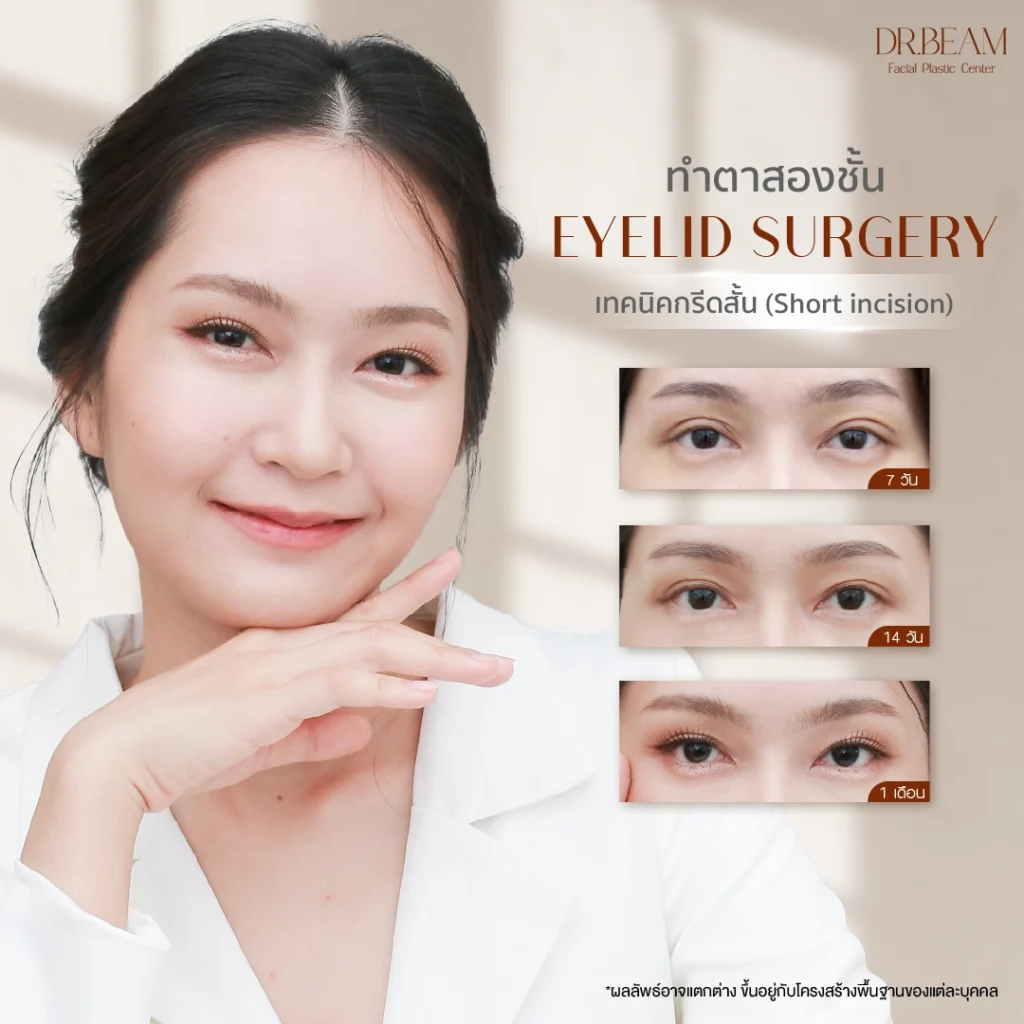 การทำตาสองชั้น เทคนิคกรีดสั้น (Short incision)